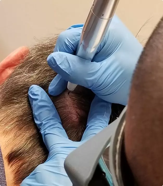 about us - hair transplant near me